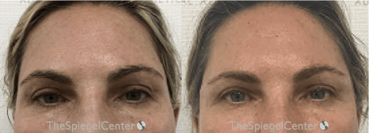 Temple Filler Before & After Gallery - Patient 923557 - Image 1