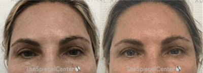 Temple Filler Before & After Gallery - Patient 923557 - Image 1