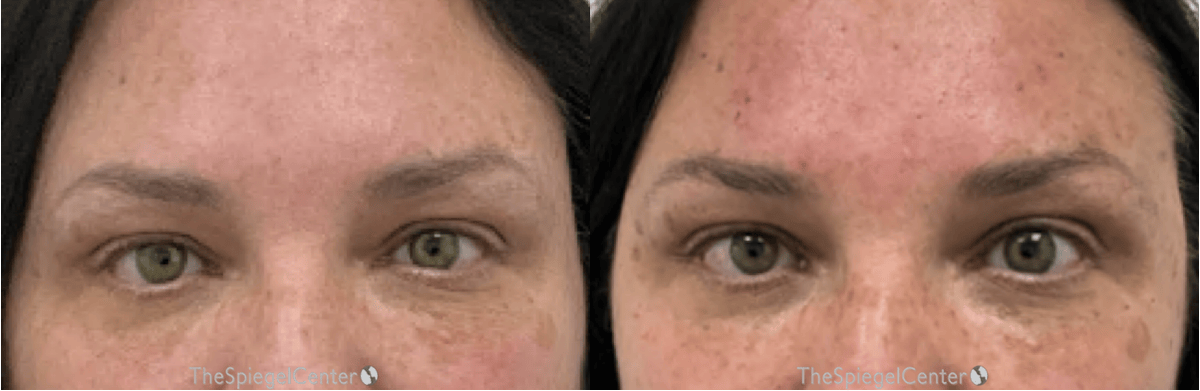 Temple Filler Before & After Gallery - Patient 306971 - Image 1