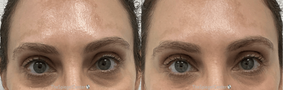 Temple Filler Before & After Gallery - Patient 357309 - Image 1