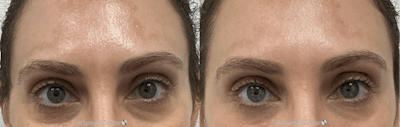 Temple Filler Before & After Gallery - Patient 357309 - Image 1