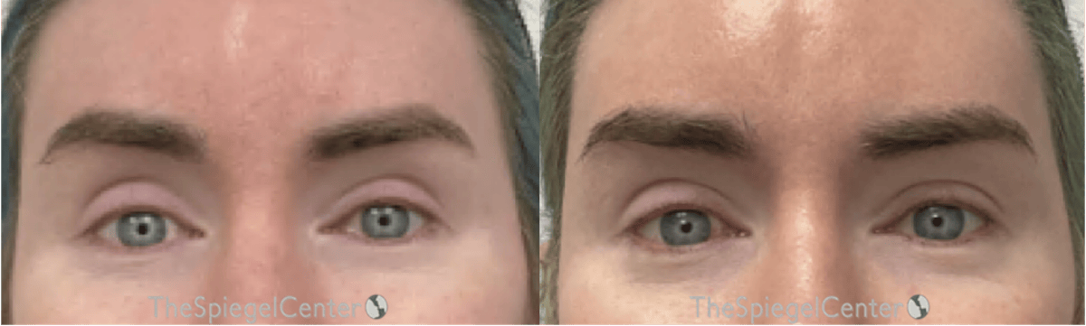 Temple Filler Before & After Gallery - Patient 233698 - Image 1