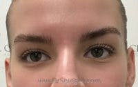 Temple Filler Before & After Gallery - Patient 417322 - Image 1