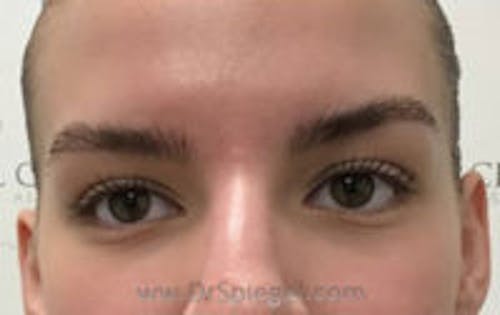 Temple Filler Before & After Gallery - Patient 417322 - Image 1