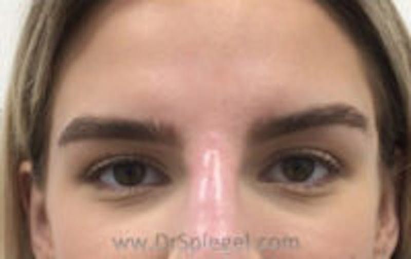 Temple Filler Before & After Gallery - Patient 417322 - Image 2
