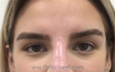 Temple Filler Before & After Gallery - Patient 417322 - Image 2