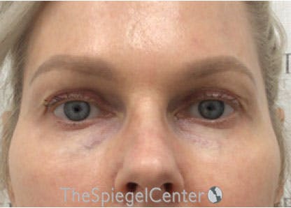 Temple Filler Before & After Gallery - Patient 224806 - Image 1