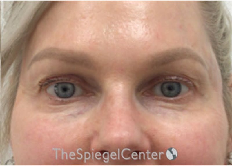 Temple Filler Before & After Gallery - Patient 224806 - Image 2