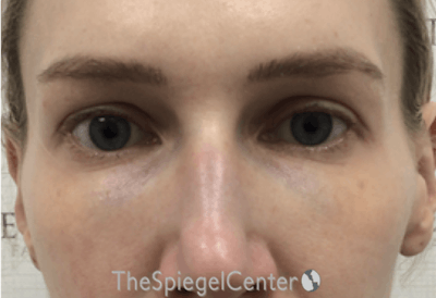 Temple Filler Before & After Gallery - Patient 335020 - Image 1
