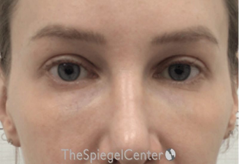Temple Filler Before & After Gallery - Patient 335020 - Image 2