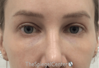 Temple Filler Before & After Gallery - Patient 335020 - Image 2