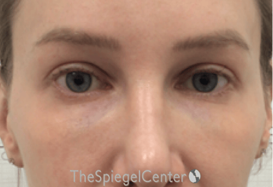 Temple Filler Before & After Gallery - Patient 335020 - Image 2
