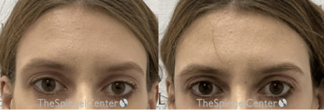 Temple Filler Before & After Gallery - Patient 992831 - Image 1