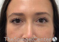 Temple Filler Before & After Gallery - Patient 791142 - Image 1