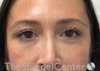 Temple Filler Before & After Gallery - Patient 791142 - Image 2