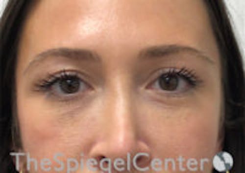 Temple Filler Before & After Gallery - Patient 791142 - Image 2