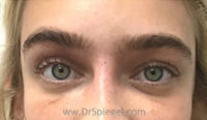 Temple Filler Before & After Gallery - Patient 328119 - Image 1