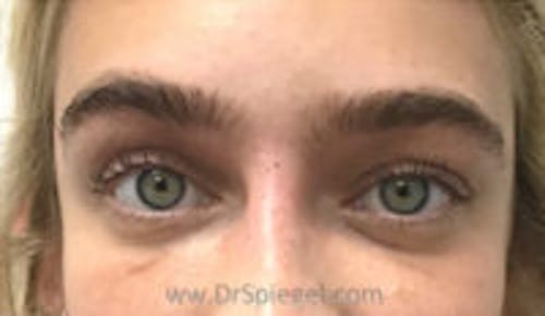 Temple Filler Before & After Gallery - Patient 328119 - Image 1