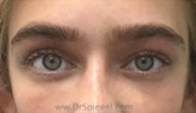 Temple Filler Before & After Gallery - Patient 328119 - Image 2