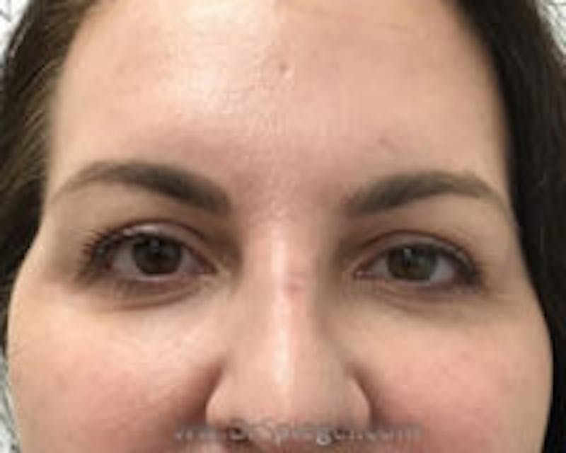 Temple Filler Before & After Gallery - Patient 152447 - Image 1