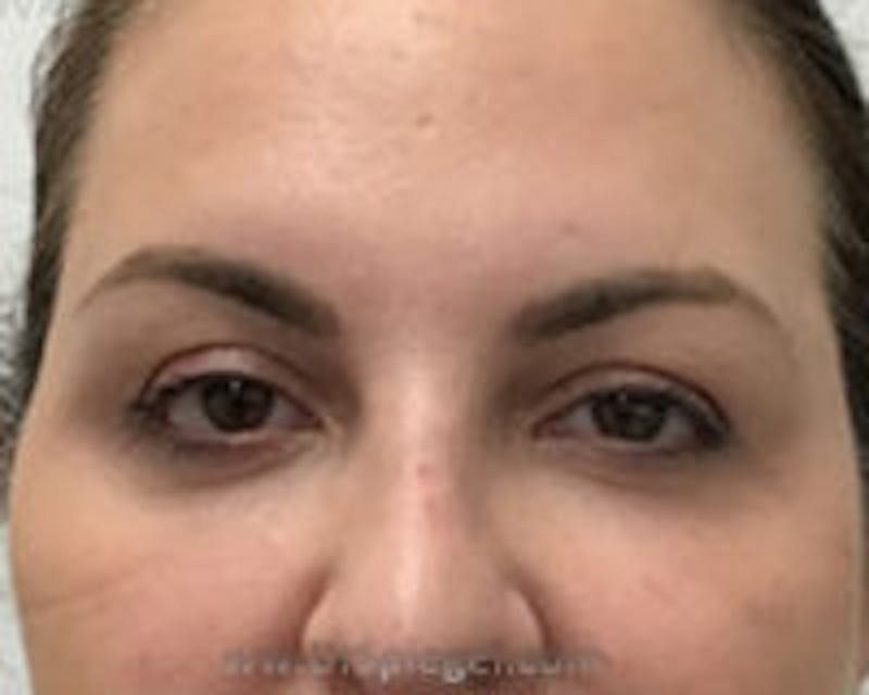 Temple Filler Before & After Gallery - Patient 152447 - Image 2