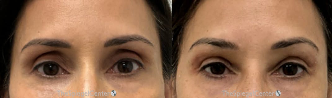 Temple Filler Before & After Gallery - Patient 990469 - Image 1