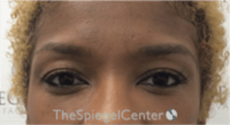 Temple Filler Before & After Gallery - Patient 455968 - Image 1