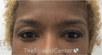 Temple Filler Before & After Gallery - Patient 455968 - Image 1