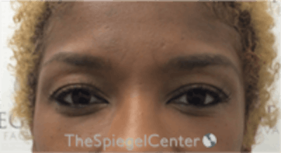 Temple Filler Before & After Gallery - Patient 455968 - Image 1