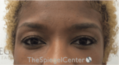 Temple Filler Before & After Gallery - Patient 455968 - Image 1