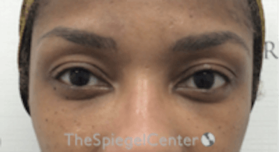 Temple Filler Before & After Gallery - Patient 455968 - Image 2