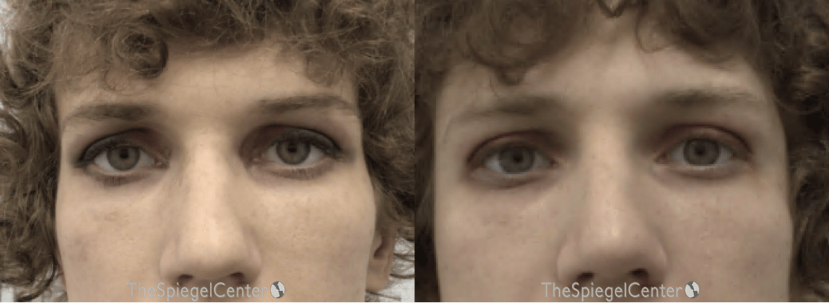 Temple Filler Before & After Gallery - Patient 208513 - Image 1