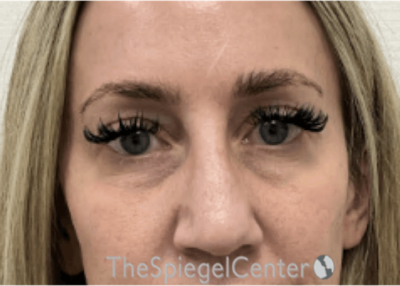 Temple Filler Before & After Gallery - Patient 249200 - Image 1