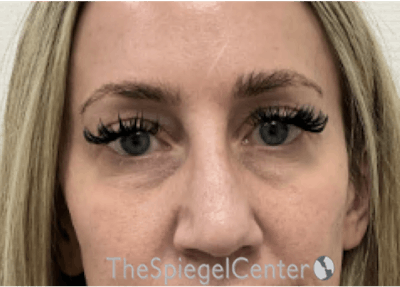 Temple Filler Before & After Gallery - Patient 249200 - Image 1