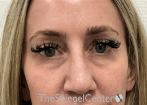 Temple Filler Before & After Gallery - Patient 249200 - Image 1