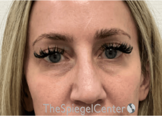 Temple Filler Before & After Gallery - Patient 249200 - Image 1