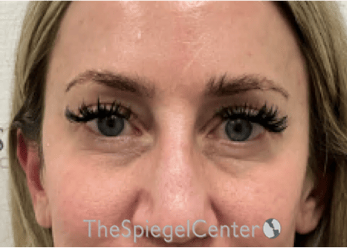 Temple Filler Before & After Gallery - Patient 249200 - Image 2
