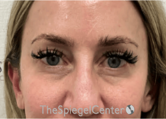 Temple Filler Before & After Gallery - Patient 249200 - Image 2