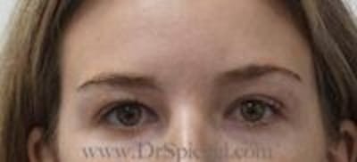 Temple Filler Before & After Gallery - Patient 815932 - Image 1