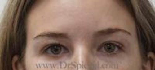 Temple Filler Before & After Gallery - Patient 815932 - Image 1
