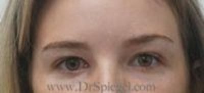 Temple Filler Before & After Gallery - Patient 815932 - Image 2