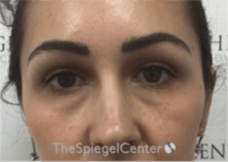 Temple Filler Before & After Gallery - Patient 273305 - Image 1