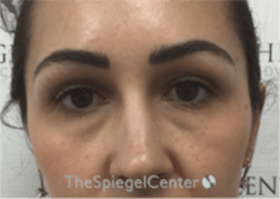 Temple Filler Before & After Gallery - Patient 273305 - Image 1