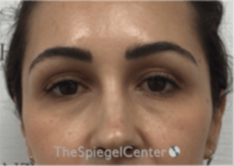 Temple Filler Before & After Gallery - Patient 273305 - Image 2