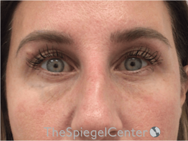 Temple Filler Before & After Gallery - Patient 357478 - Image 1