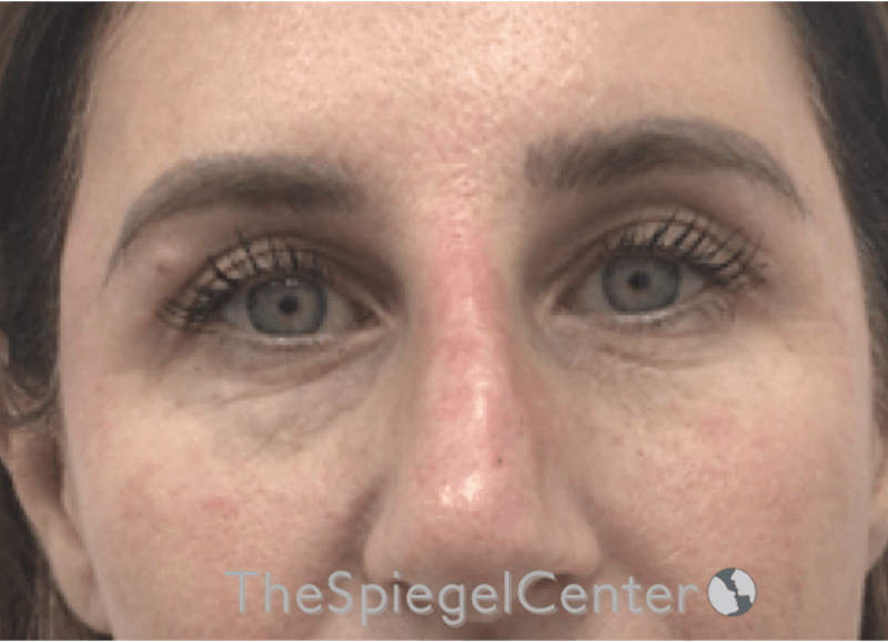 Temple Filler Before & After Gallery - Patient 357478 - Image 2