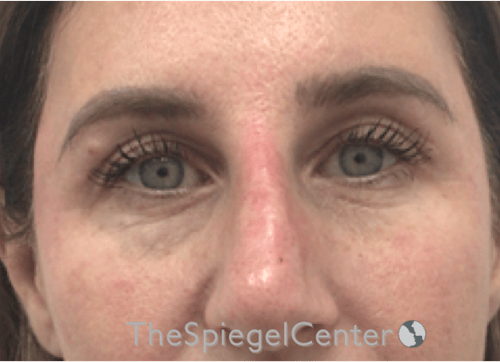 Temple Filler Before & After Gallery - Patient 357478 - Image 2