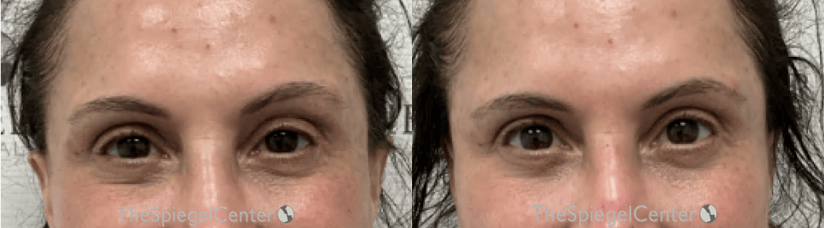 Temple Filler Before & After Gallery - Patient 263916 - Image 1