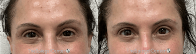 Temple Filler Before & After Gallery - Patient 263916 - Image 1