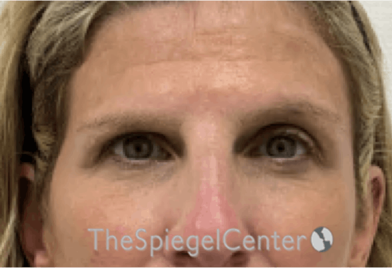 Temple Filler Before & After Gallery - Patient 326430 - Image 1
